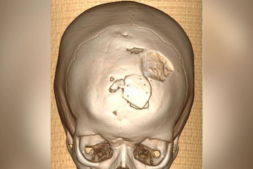 В Зауралье хирурги устранили сложный дефект черепа у ребёнка